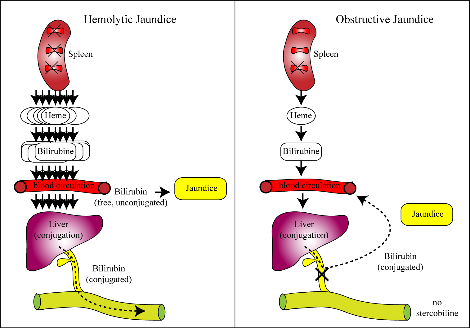 jaundice